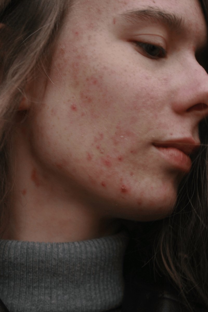 best acids to treat acne